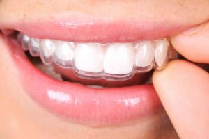 Invisalign mascherine invisibili