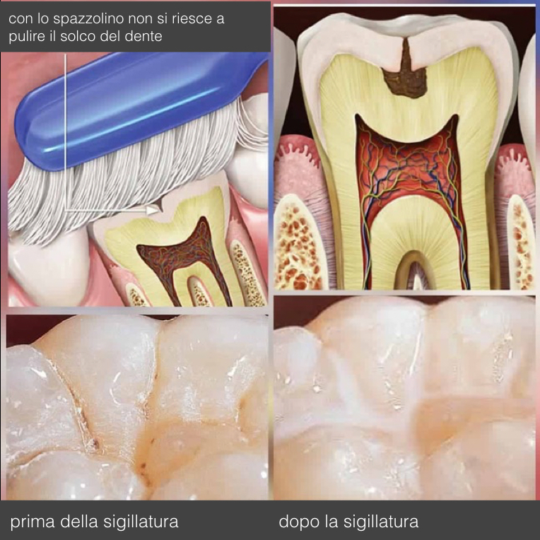 Sigillature dei denti per la prevenzione della carie