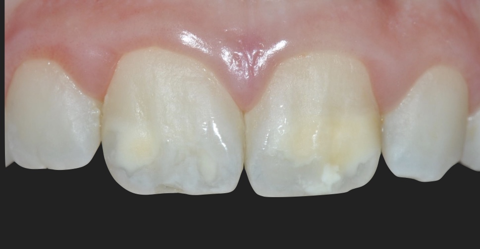 MIH: cosa sono queste macchie bianche sui denti?