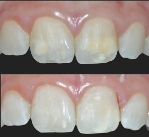Le macchie bianche sui denti si possono trattare