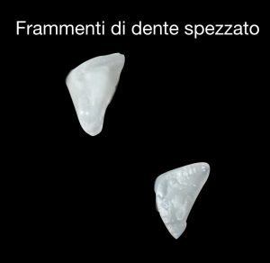 Il frammento di dente va tenuto in soluzione acquosa