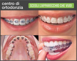 apparecchio dentale a genova