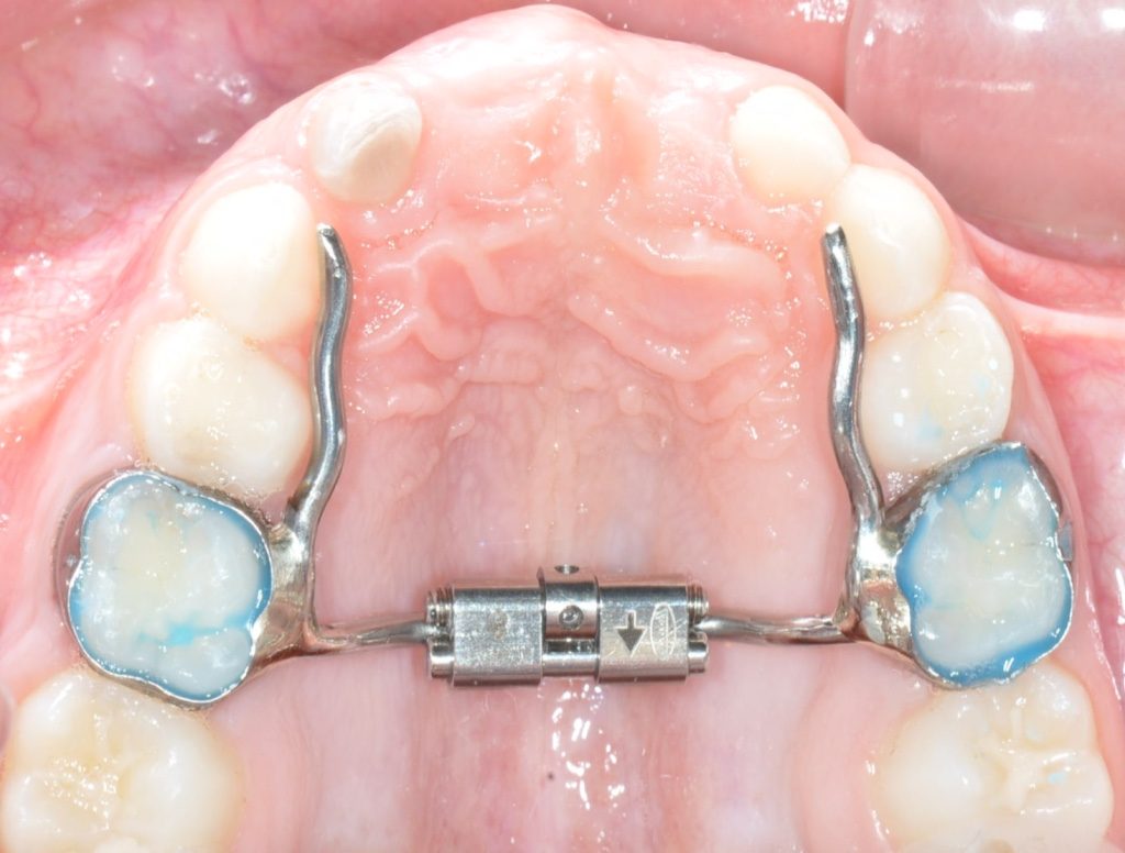 espansero nei denti da latte usato in ortodonzia infantile