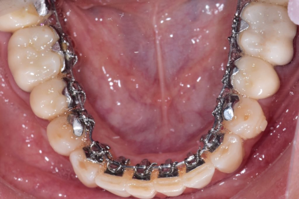 apparecchio invisibile linguale ortodonzia infantile