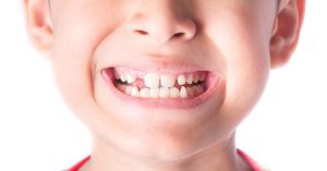 bambino con i denti storti