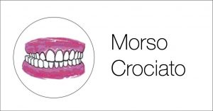 morso crociato malocclusione ortodonzia genova