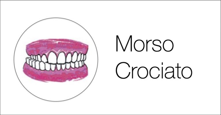 morso crociato malocclusione ortodonzia genova