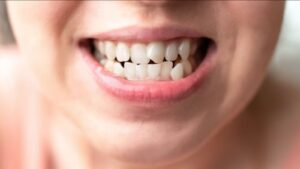 denti-incisivi-storti